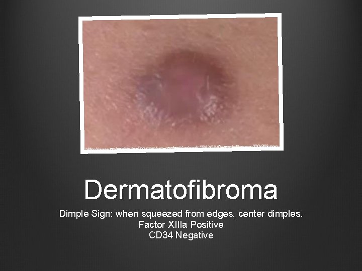 Dermatofibroma Dimple Sign: when squeezed from edges, center dimples. Factor XIIIa Positive CD 34