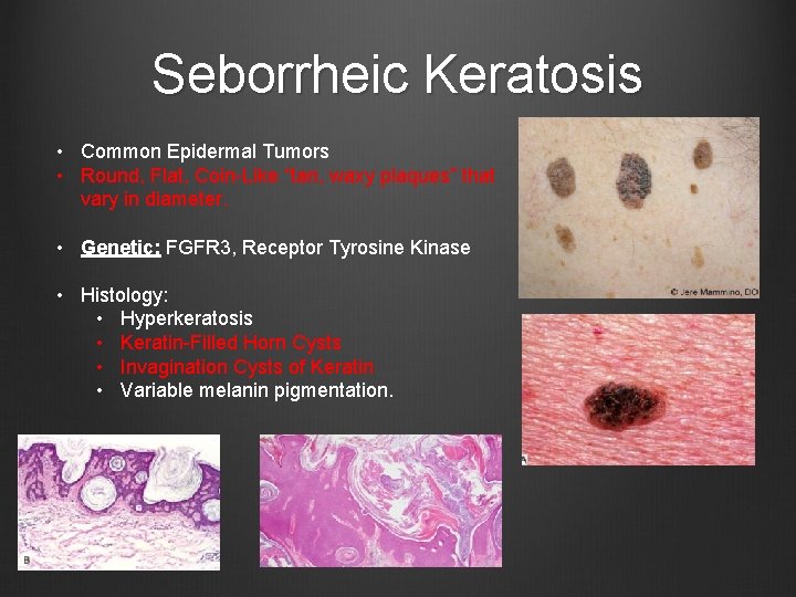 Seborrheic Keratosis • Common Epidermal Tumors • Round, Flat, Coin-Like “tan, waxy plaques” that