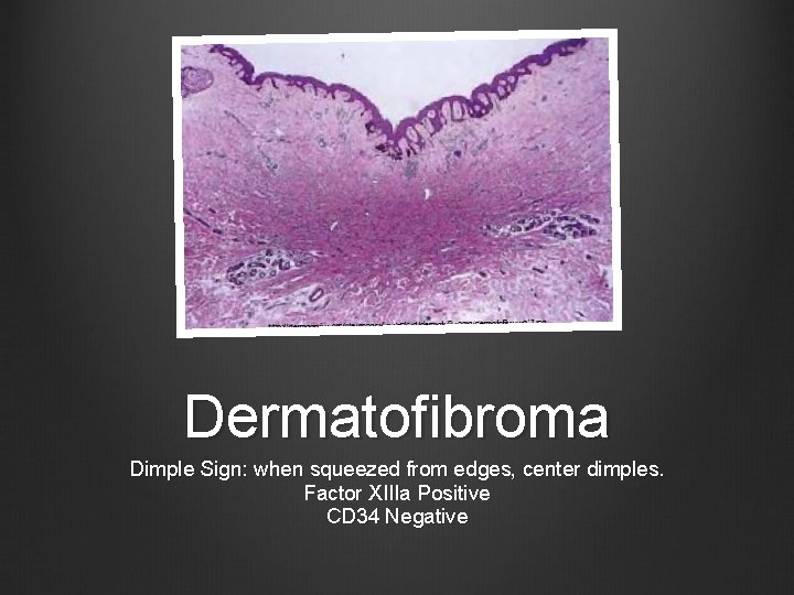 Dermatofibroma Dimple Sign: when squeezed from edges, center dimples. Factor XIIIa Positive CD 34