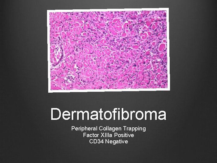 Dermatofibroma Peripheral Collagen Trapping Factor XIIIa Positive CD 34 Negative 