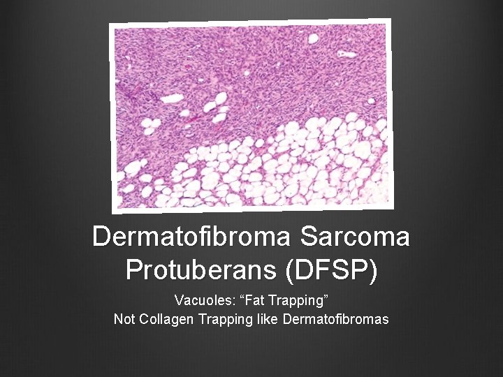 Dermatofibroma Sarcoma Protuberans (DFSP) Vacuoles: “Fat Trapping” Not Collagen Trapping like Dermatofibromas 