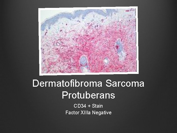 Dermatofibroma Sarcoma Protuberans CD 34 + Stain Factor XIIIa Negative 