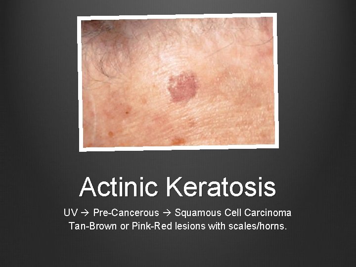 Actinic Keratosis UV Pre-Cancerous Squamous Cell Carcinoma Tan-Brown or Pink-Red lesions with scales/horns. 