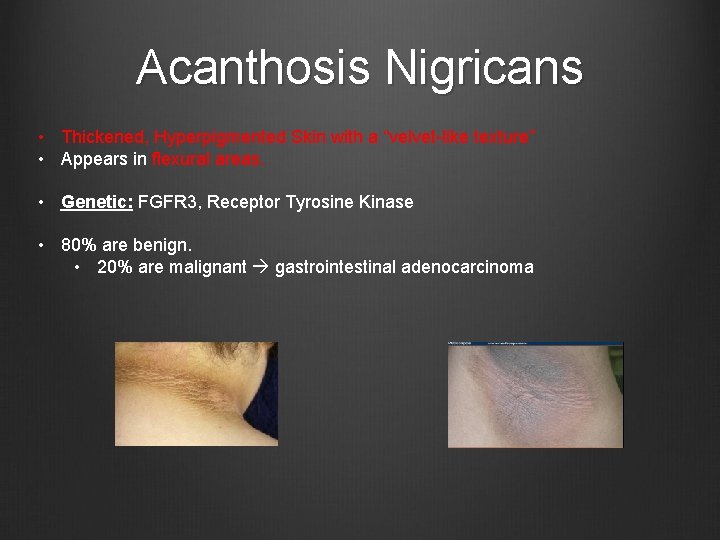 Acanthosis Nigricans • Thickened, Hyperpigmented Skin with a “velvet-like texture” • Appears in flexural