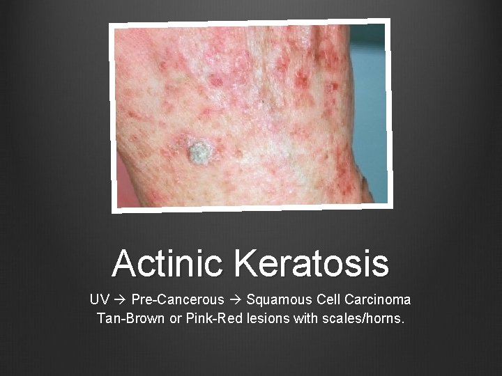 Actinic Keratosis UV Pre-Cancerous Squamous Cell Carcinoma Tan-Brown or Pink-Red lesions with scales/horns. 