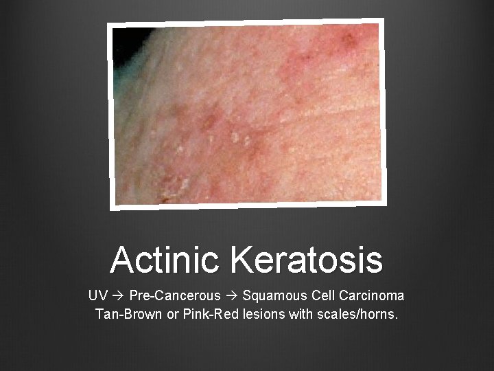 Actinic Keratosis UV Pre-Cancerous Squamous Cell Carcinoma Tan-Brown or Pink-Red lesions with scales/horns. 