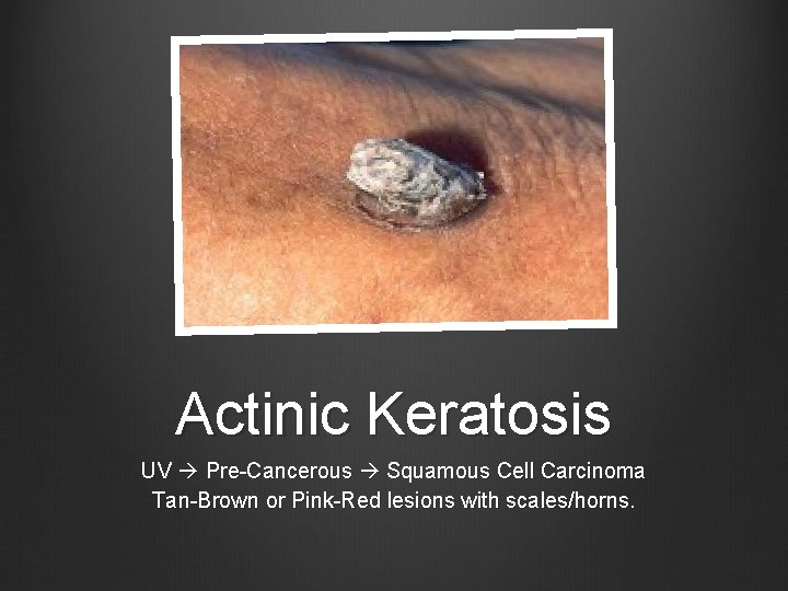 Actinic Keratosis UV Pre-Cancerous Squamous Cell Carcinoma Tan-Brown or Pink-Red lesions with scales/horns. 