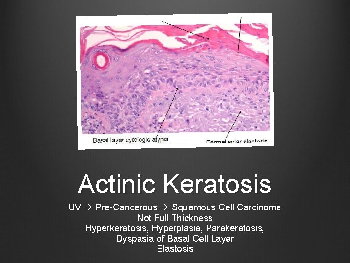 Actinic Keratosis UV Pre-Cancerous Squamous Cell Carcinoma Not Full Thickness Hyperkeratosis, Hyperplasia, Parakeratosis, Dyspasia