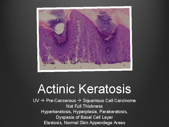 Actinic Keratosis UV Pre-Cancerous Squamous Cell Carcinoma Not Full Thickness Hyperkeratosis, Hyperplasia, Parakeratosis, Dyspasia