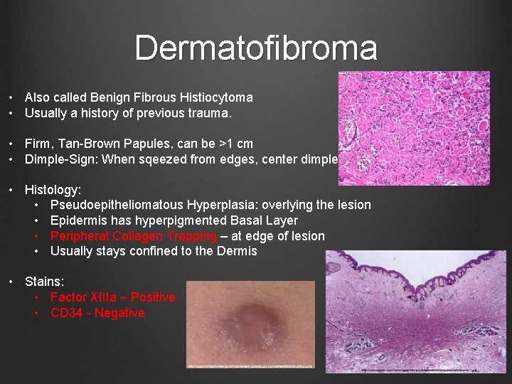 Dermatofibroma • Also called Benign Fibrous Histiocytoma • Usually a history of previous trauma.