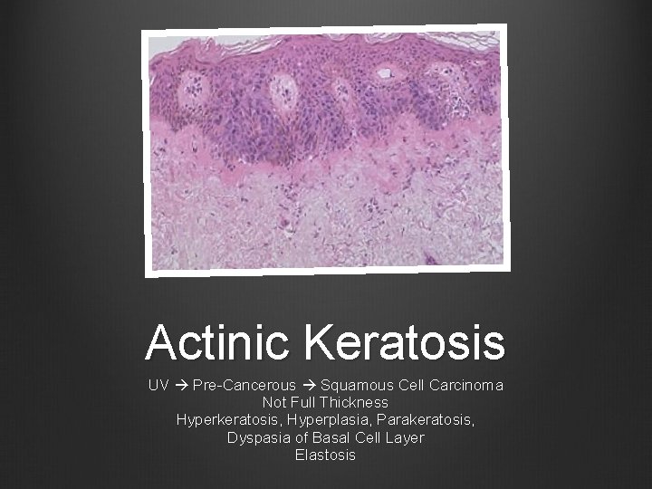 Actinic Keratosis UV Pre-Cancerous Squamous Cell Carcinoma Not Full Thickness Hyperkeratosis, Hyperplasia, Parakeratosis, Dyspasia