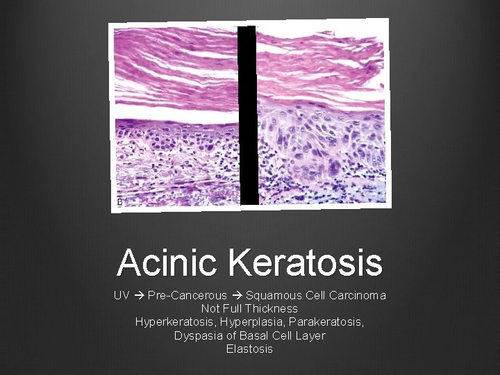 Acinic Keratosis UV Pre-Cancerous Squamous Cell Carcinoma Not Full Thickness Hyperkeratosis, Hyperplasia, Parakeratosis, Dyspasia