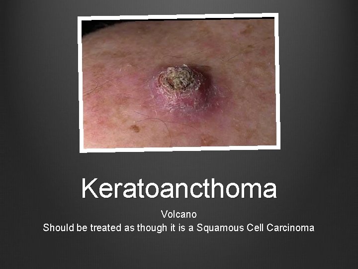 Keratoancthoma Volcano Should be treated as though it is a Squamous Cell Carcinoma 