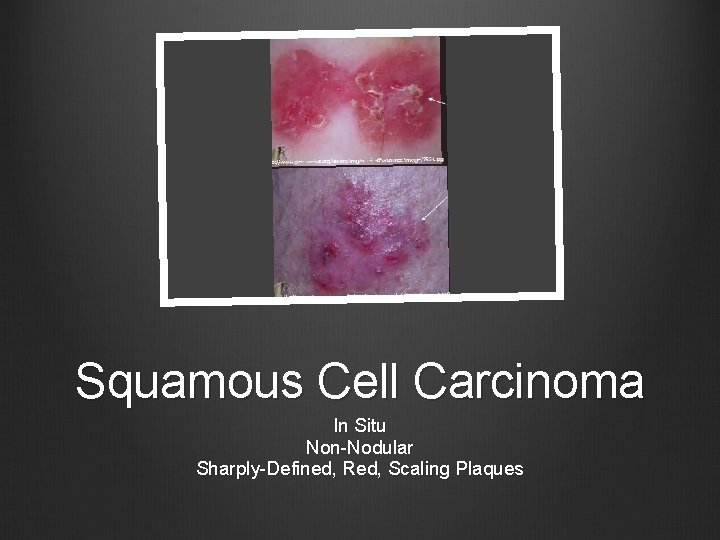 Squamous Cell Carcinoma In Situ Non-Nodular Sharply-Defined, Red, Scaling Plaques 