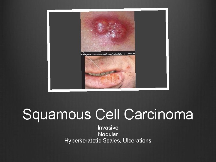 Squamous Cell Carcinoma Invasive Nodular Hyperkeratotic Scales, Ulcerations 