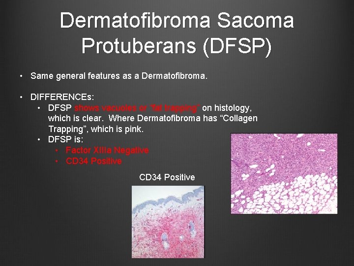 Dermatofibroma Sacoma Protuberans (DFSP) • Same general features as a Dermatofibroma. • DIFFERENCEs: •
