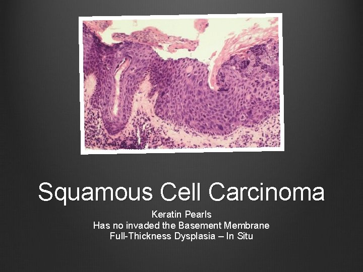 Squamous Cell Carcinoma Keratin Pearls Has no invaded the Basement Membrane Full-Thickness Dysplasia –