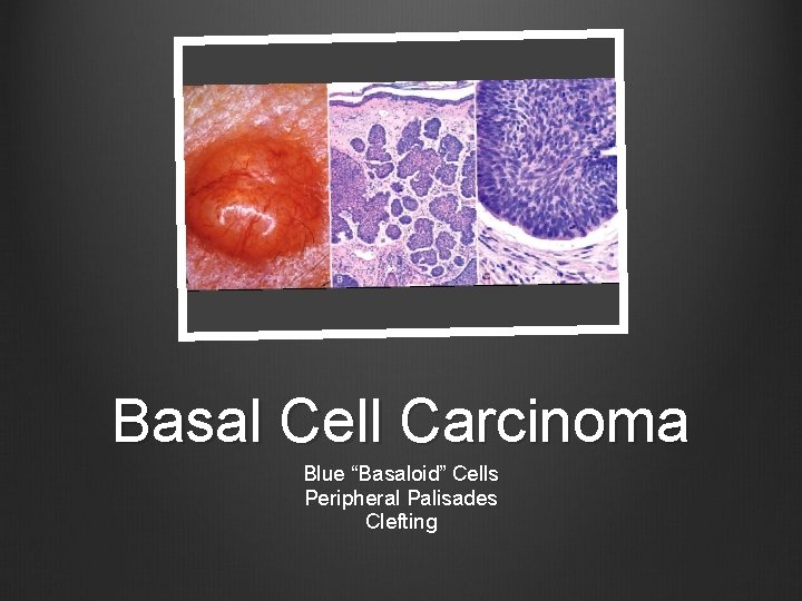 Basal Cell Carcinoma Blue “Basaloid” Cells Peripheral Palisades Clefting 