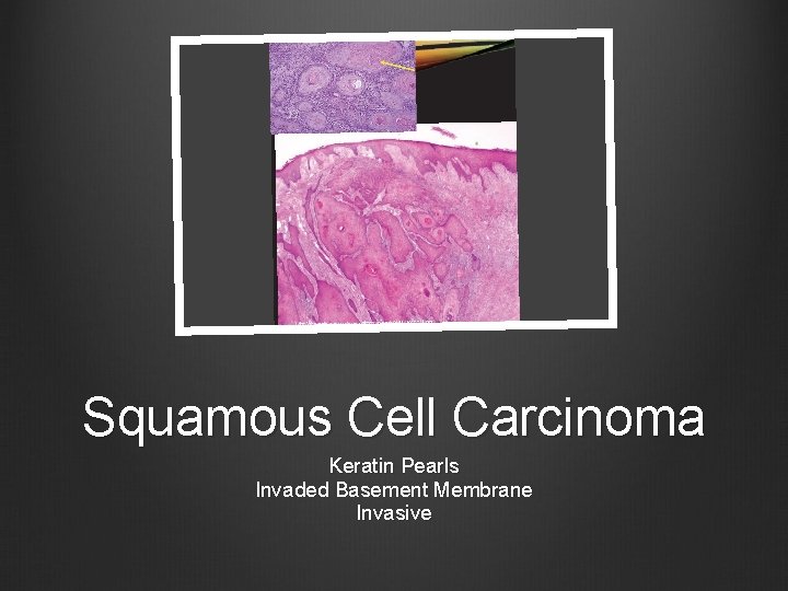 Squamous Cell Carcinoma Keratin Pearls Invaded Basement Membrane Invasive 