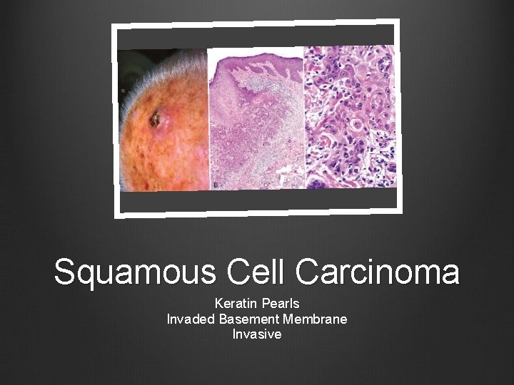 Squamous Cell Carcinoma Keratin Pearls Invaded Basement Membrane Invasive 