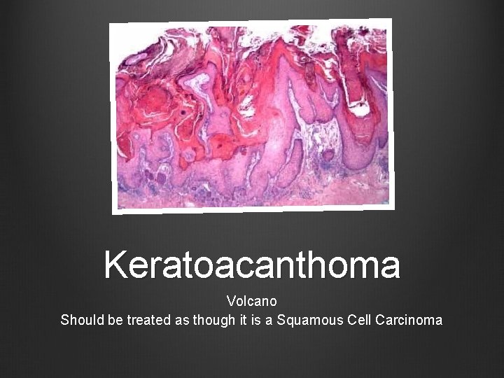 Keratoacanthoma Volcano Should be treated as though it is a Squamous Cell Carcinoma 