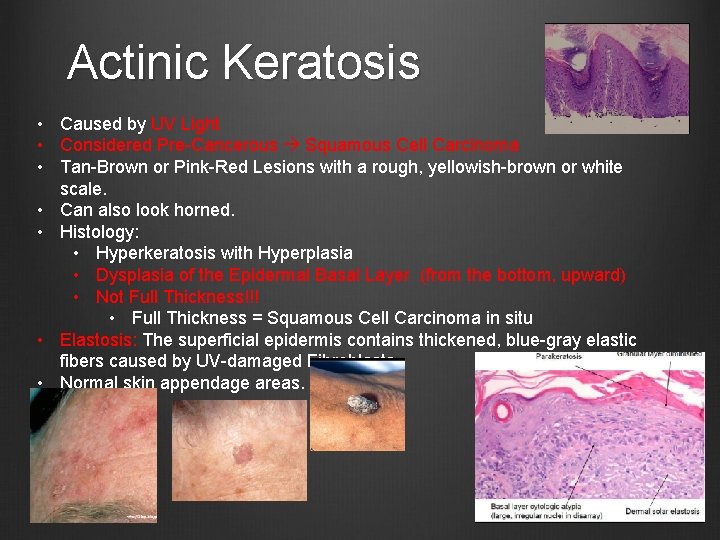 Actinic Keratosis • Caused by UV Light • Considered Pre-Cancerous Squamous Cell Carcinoma •