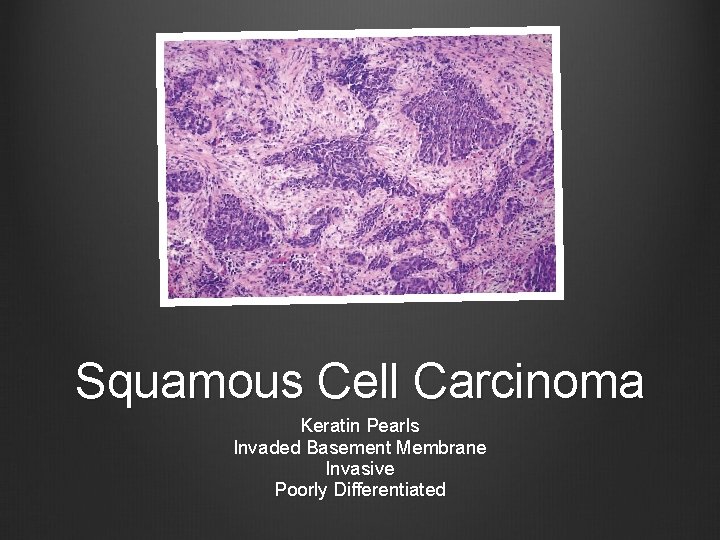 Squamous Cell Carcinoma Keratin Pearls Invaded Basement Membrane Invasive Poorly Differentiated 