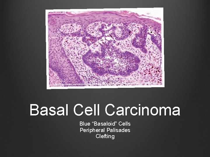 Basal Cell Carcinoma Blue “Basaloid” Cells Peripheral Palisades Clefting 
