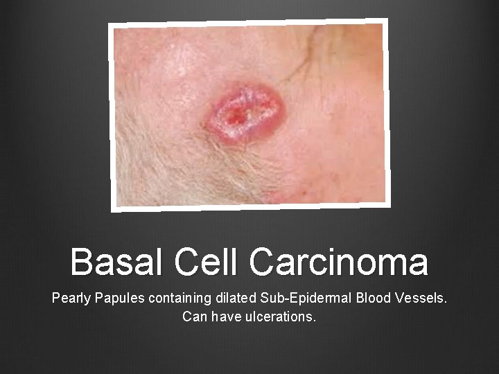 Basal Cell Carcinoma Pearly Papules containing dilated Sub-Epidermal Blood Vessels. Can have ulcerations. 