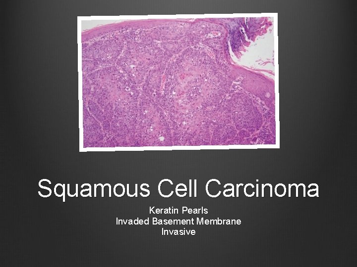 Squamous Cell Carcinoma Keratin Pearls Invaded Basement Membrane Invasive 