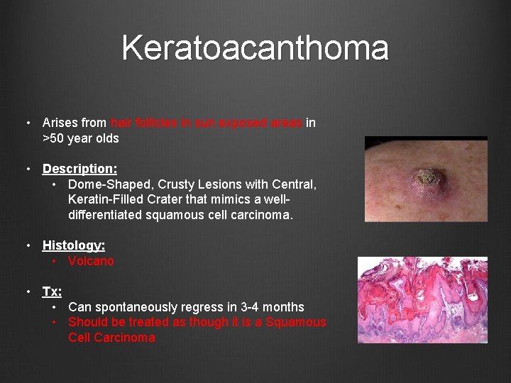 Keratoacanthoma • Arises from hair follicles in sun exposed areas in >50 year olds