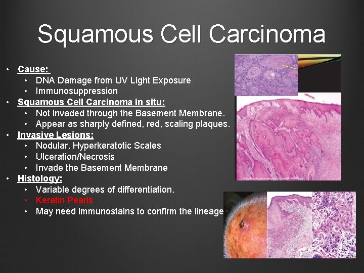 Squamous Cell Carcinoma • Cause: • DNA Damage from UV Light Exposure • Immunosuppression