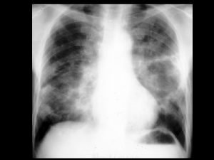 Cryptogenic organizing pneumonia COP Findings patchy airspace consolidation