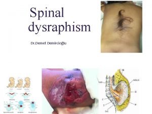Spinal dysraphism Dr Demet Demirciolu Formation and separation