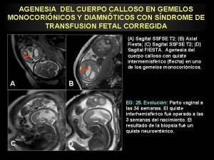 Agenesia cuerpo calloso ecografia fetal