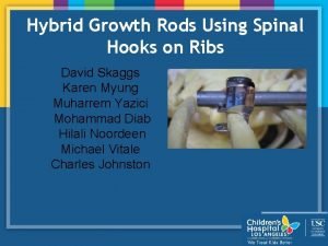 Hybrid Growth Rods Using Spinal Hooks on Ribs