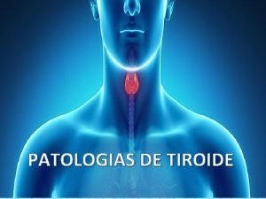 PATOLOGIAS DE TIROIDE Carcinoma papilar Definicin Es el