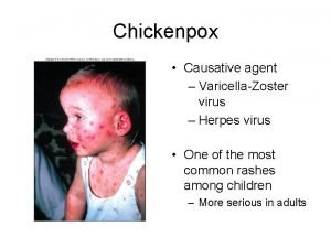 Chickenpox Causative agent VaricellaZoster virus Herpes virus One