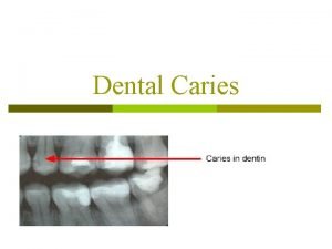 Dental Caries Dental caries destroy the mineral component