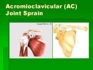 Acromioclavicular AC Joint Sprain What is the AC