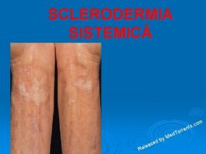 SCLERODERMIA SISTEMIC m o ts c d Me