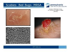 Scabies description