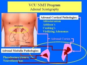 VCU NMT Program Adrenal Scintigraphy Adrenal Cortical Pathologies