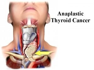 Anaplastic Thyroid Cancer Introduction Anaplastic thyroid cancers ATC