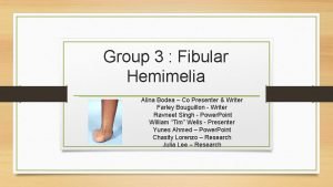 Fibular hemimelia
