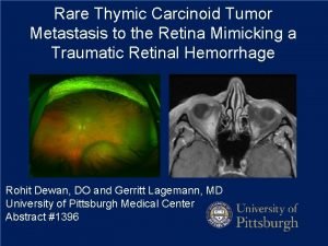 Rare Thymic Carcinoid Tumor Metastasis to the Retina