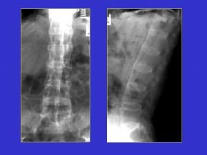 BAMBOO SPINE Diagnosis Ankylosing Spondylitis Discussion Anterior and