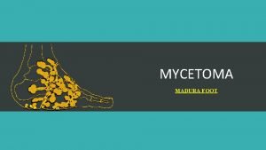 MYCETOMA MADURA FOOT Chronic localized subcutaneous mycotic infection