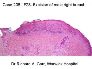 Case 206 F 28 Excision of mole right
