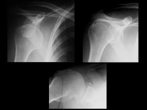 Subcoracoid dislocation